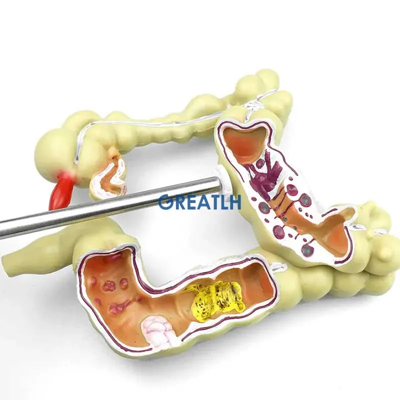 Colorectal Lesion Model Human Colon Snake Large Intestine Pathological Diseases Model Medical Organizer Anatomy