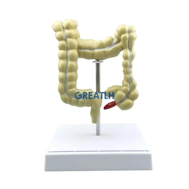 Colorectal Lesion Model Human Colon Snake Large Intestine Pathological Diseases Model Medical Organizer Anatomy