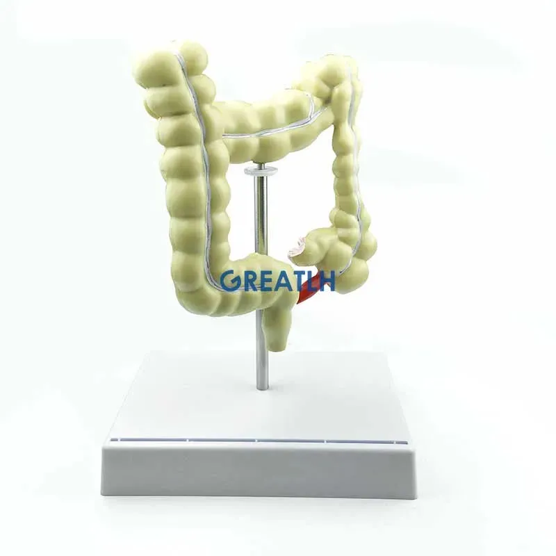 Colorectal Lesion Model Human Colon Snake Large Intestine Pathological Diseases Model Medical Organizer Anatomy